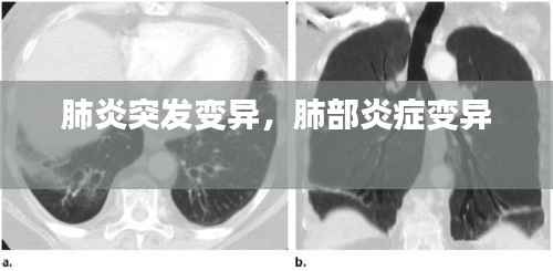 肺炎突发变异,肺部炎症变异